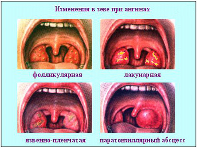 Лекарства при ангине: какие лекарства пить при гнойной ангине, их разновидности