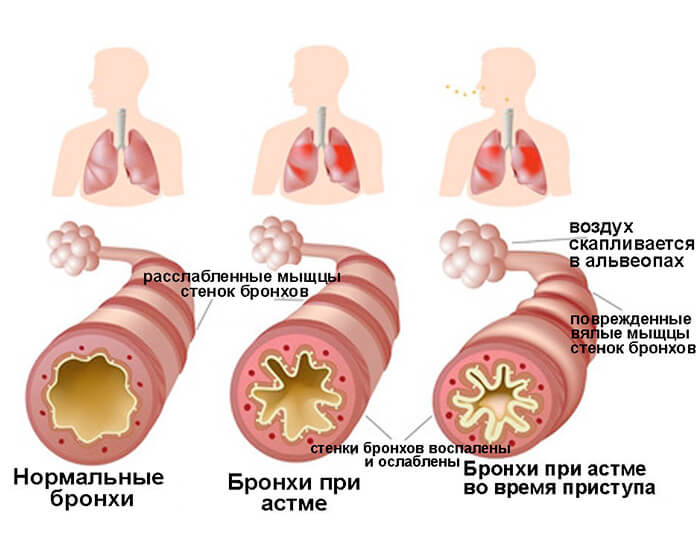 Что такое бронхиальная астма
