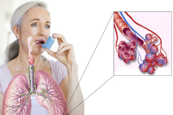 Признаки астмы у взрослого - часто повторяющиеся приступы кашля, сопровождающегося хрипами и свистом в груди