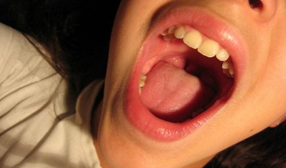 Осиплость голоса без боли в горле: причины, лечение и профилактика