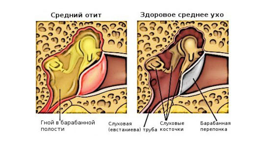 Воспаление среднего уха (средний отит): симптомы острого и хронического заболевания уха