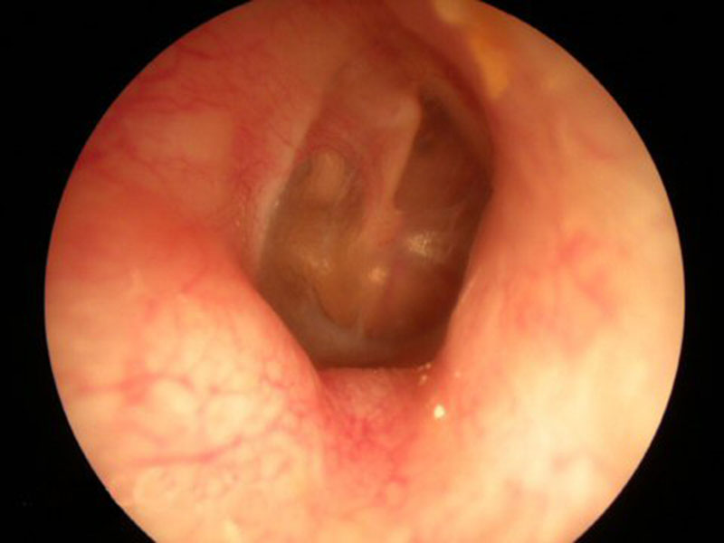 Отит наружного уха: признаки, диагностика и лечение