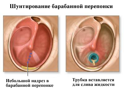 Как лечить гнойный отит среднего уха, лечение острого диффузного отита наружного уха