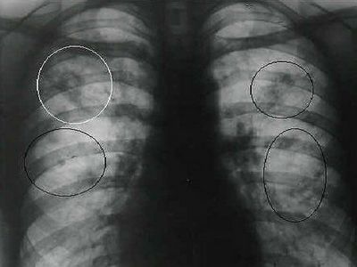 Рентгенография грудной клетки: обзорная и цифровая рентгенография органов грудной клетки, показания и проведение