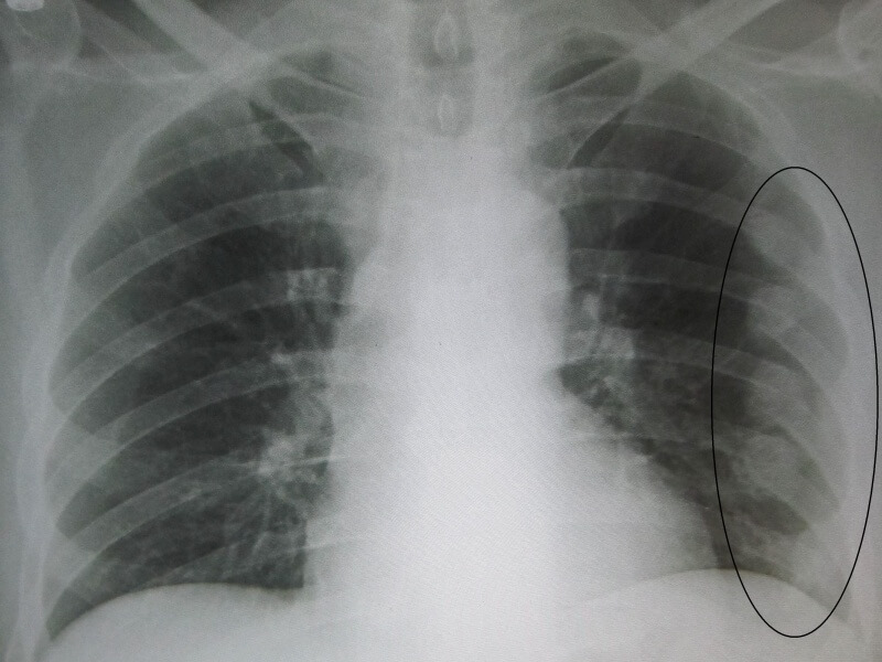 Боль при дыхании в грудной клетке, в сердце и в легких: особенности проявления боли при дыхании
