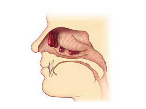 Что такое полипозный синусит: симптомы и лечение полипов в носу, как диагностируется полипозный гайморит