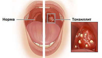 Тонзиллит у детей: его симптомы и лечение, как ухаживать за ребенком с хроническим тонзиллитом
