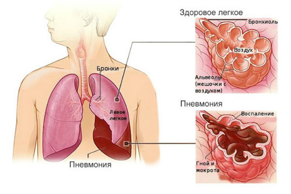 Воспаление легких у детей - инфекционное заболевание органов дыхательной системы, требующее лечения под наблюдением врача