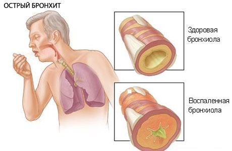 Болезни легких и их симптомы: проявления различных заболеваний дыхательной системы