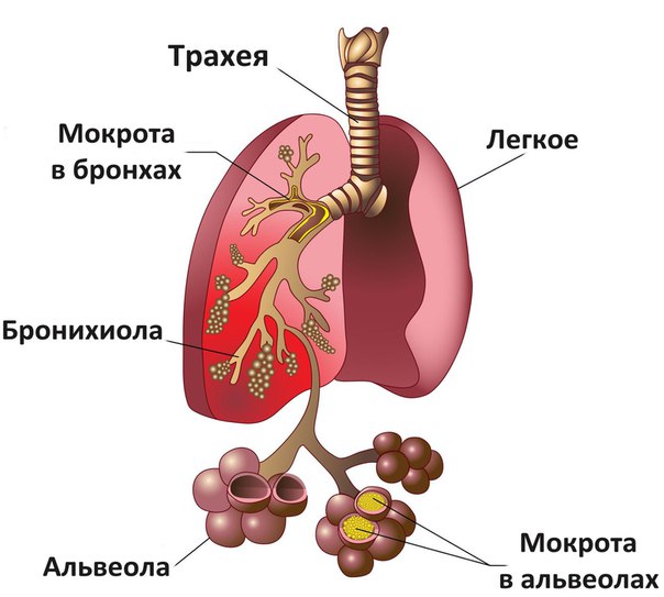 Болезни легких и их симптомы: проявления различных заболеваний дыхательной системы