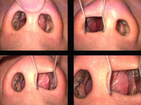 Лечение искривления носовой перегородки без операции