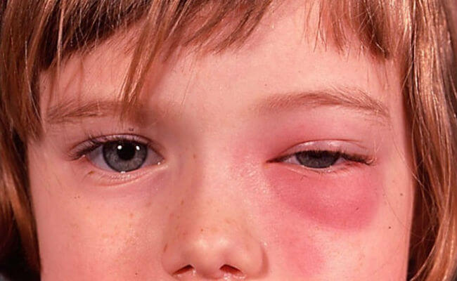 Симптомы этмоидита у детей