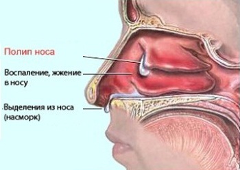 Лечение полипов в носу