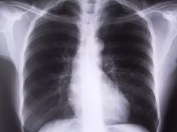 Что такое туберкулезный плеврит