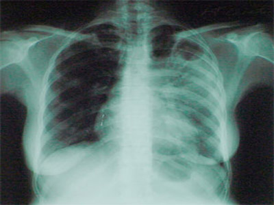 Рентген сердца, полученный при рентгенографии органов грудной клетки