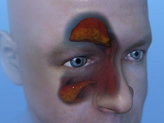 Воспаление пазух носа служит показанием для применения флемоксина при гайморите