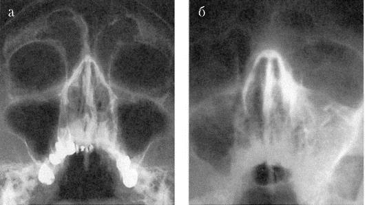 Рентген пазух в нормальном состоянии и при остром гнойном левостороннем синусите
