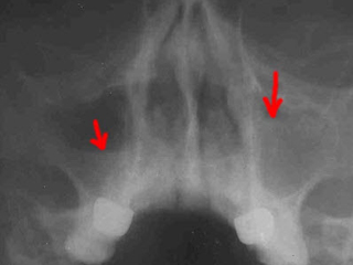 Верхнечелюстной синусит на рентгеновском снимке