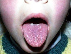 Малиновый язык - симптом скарлатины