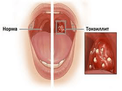 Хронический компенсированный тонзиллит характеризуется гноем на миндалинах