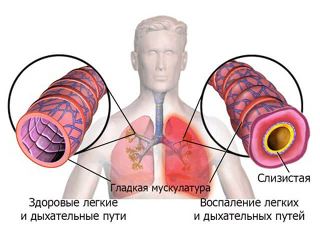 Как проявляется воспаление легких и дыхательных путей