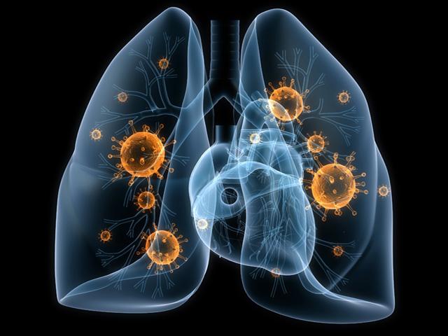 Симптомы и лечение воспаления лёгких